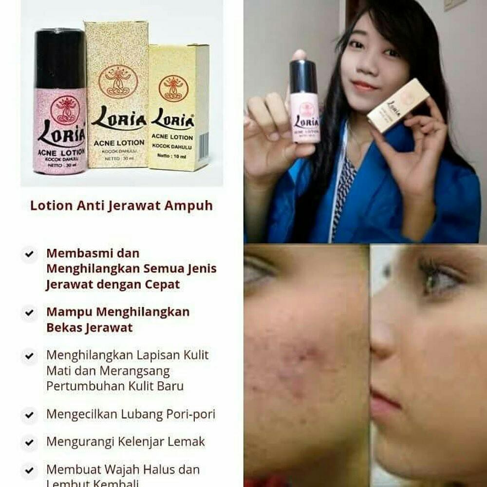 Takarai OBAT JERAWAT LOTION Loria AMPUH hanya dalam 3 Hari Menghilangkan Cepat Mengecilkan Pori-pori