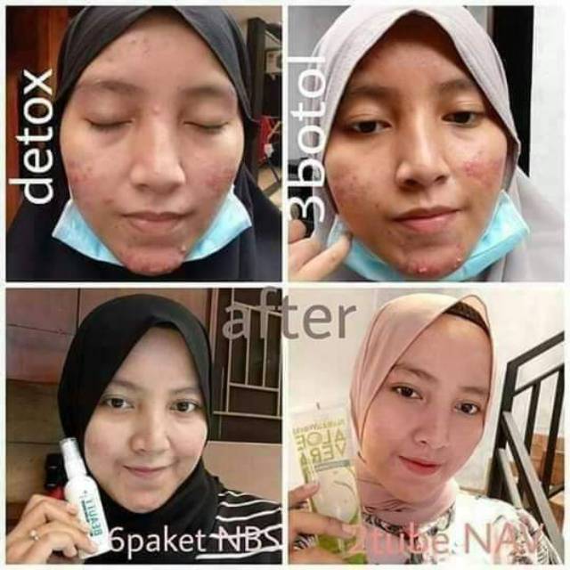 Natura Beauty Spray Serum Penghilang jerawat