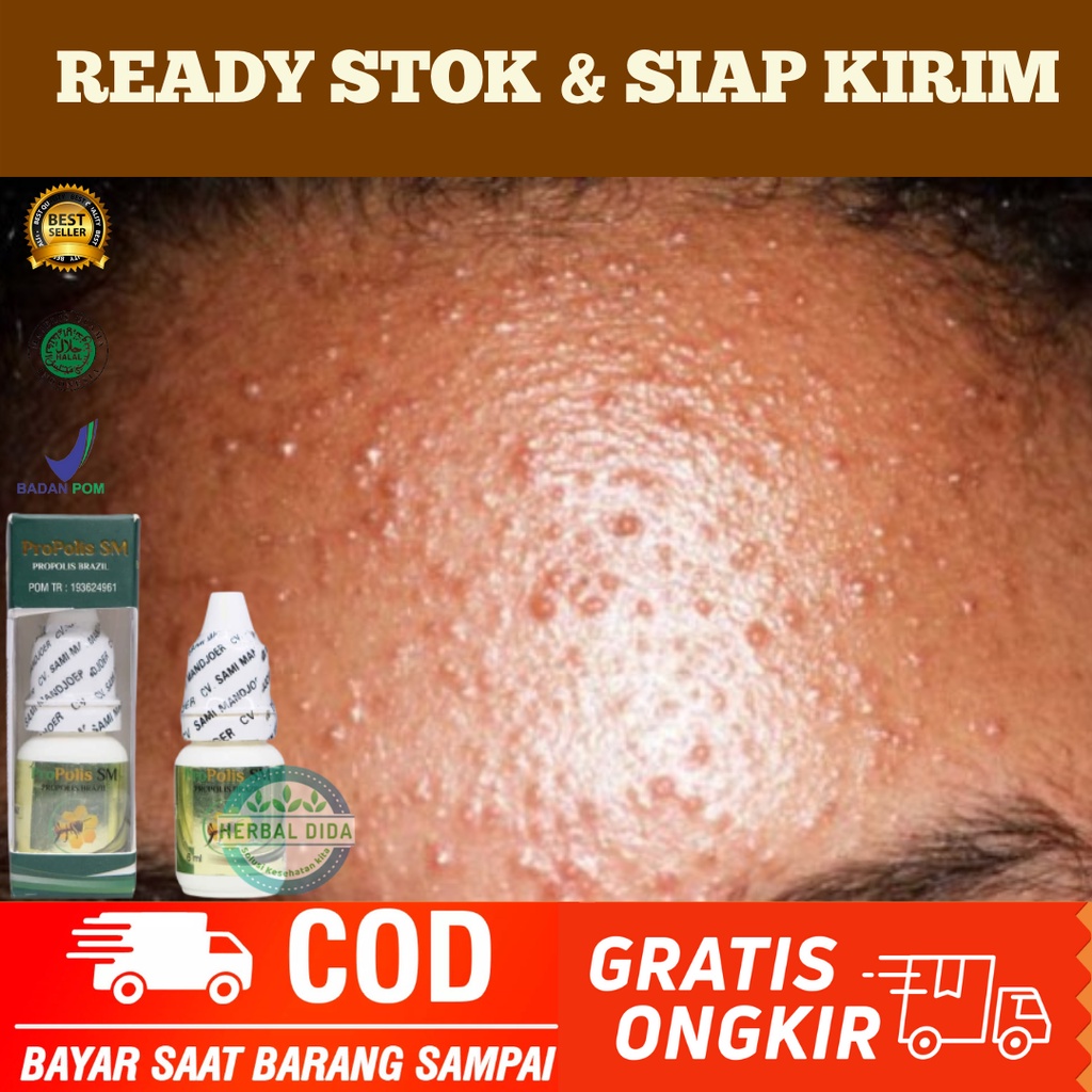 Obat oles Penghilang Bruntusan hitam Di Dahi, Obat Herbal Penghilang Bruntusan Kecil Di Dahi, Obat O