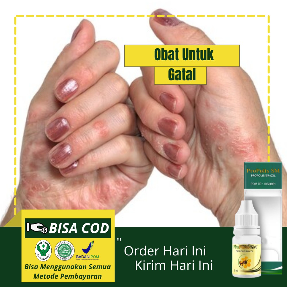 Jual Obat Gatal Telapak Tangan Herbal Telapak Tangan Gatal Muncul Bintik Berair Propolis Sm 0597