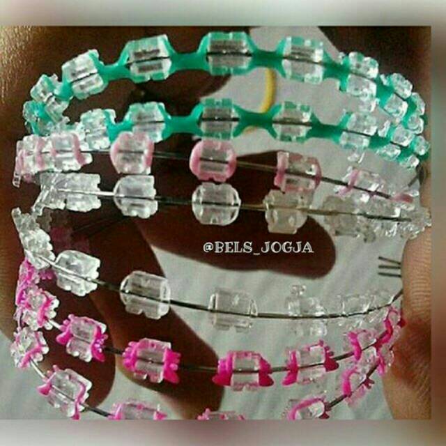 Behel lepas pasang  keramik plastik