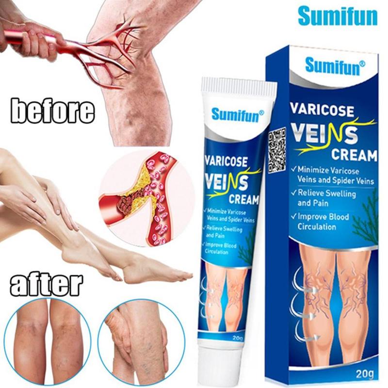 Salep Varises Cream Varicose Veins Obat Varises Kemaluan Bengkak Benjolan Buah Zakar Nyeri Testis Varicose Veins Cream 20Gr