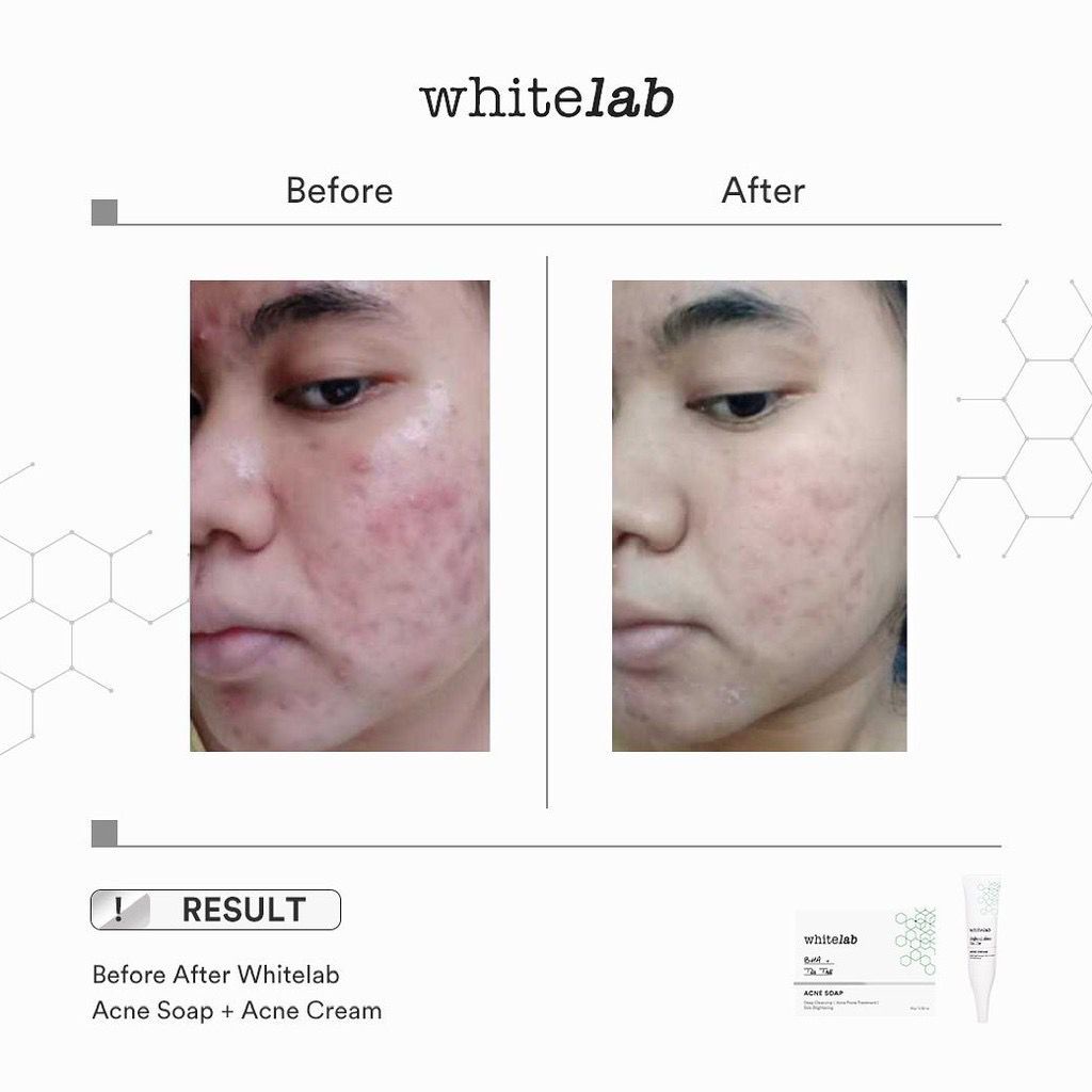 Whitelab Acne Soap Bar Sabun Wajah Berjerawat