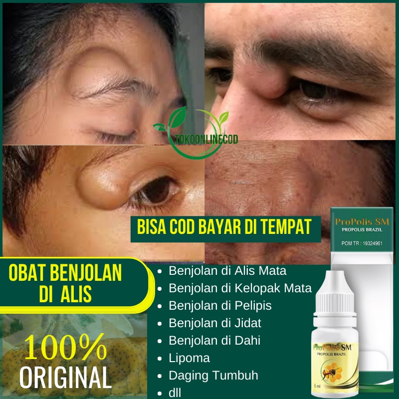 Obat Benjolan di Alis, Benjolan di Kelopak Mata, Penumpas Benjolan di Pelipis, Benjolan di Dahi, Lip