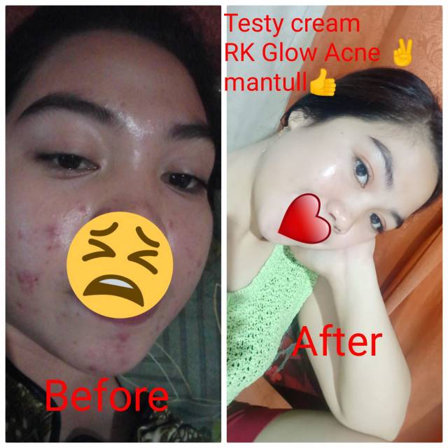 RK GLOW ACNE SKINCARE ORIGINAL