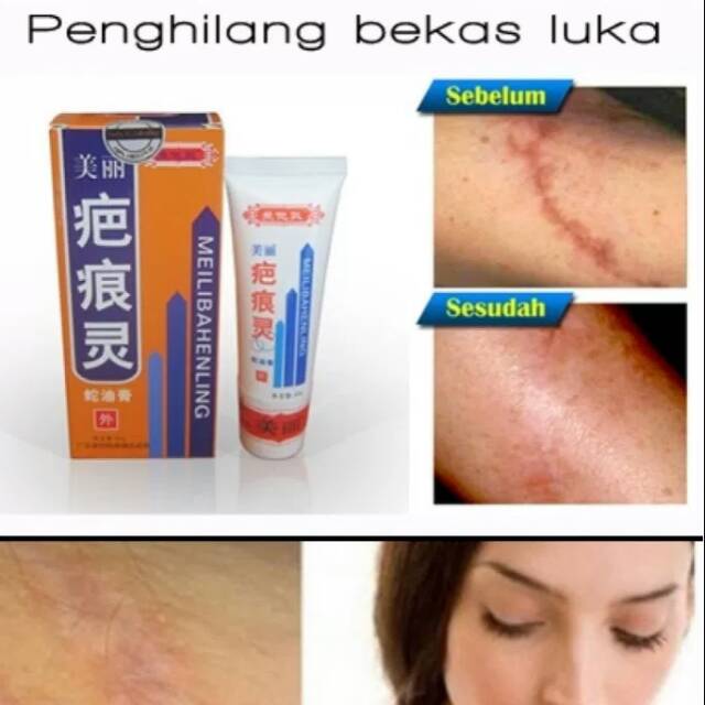 Penghilang Bekas luka MEILIBAHENLING ASLI