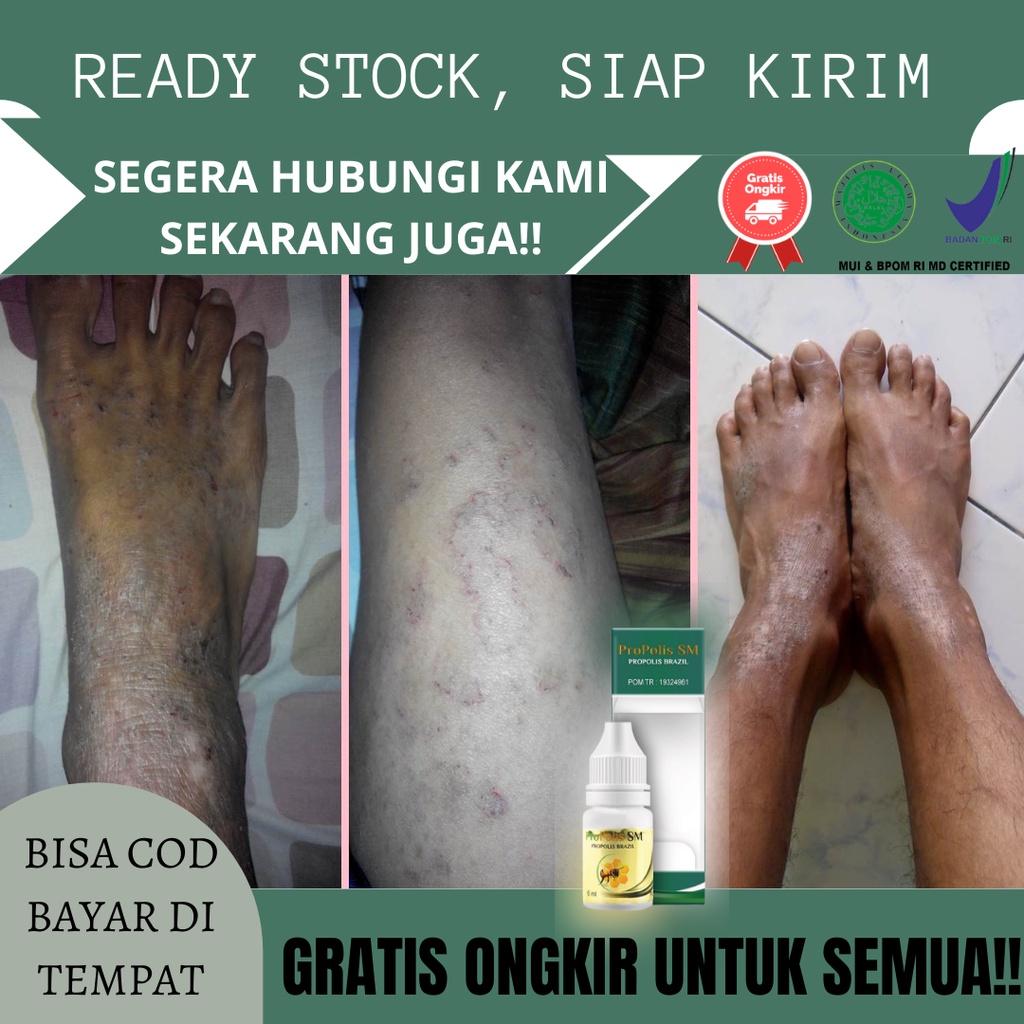 Obat Gatal Menahun Paling Murah, Obat Gatal Menahun Eksim Kering, Obat Gatal Kulit Menahun, Obat Gat