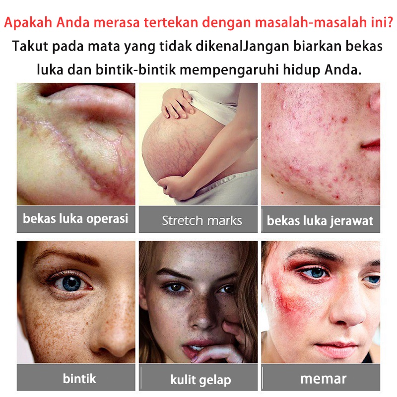 Penghilang Bekas Luka  penghilang bekas jerawat Bekas Jerawat 30g Cream Penghilan Bekas Luka Krim Ampuh Penghilang Jerawat Bekas Cacar Gatal Koreng Gigitan Nyamyuk Serangga Luka