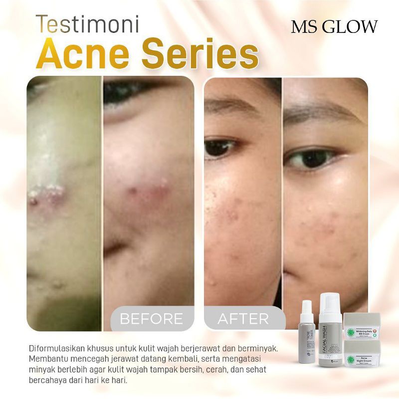 Paket Acne + Red Jelly Lactobacillus || MS GLOW