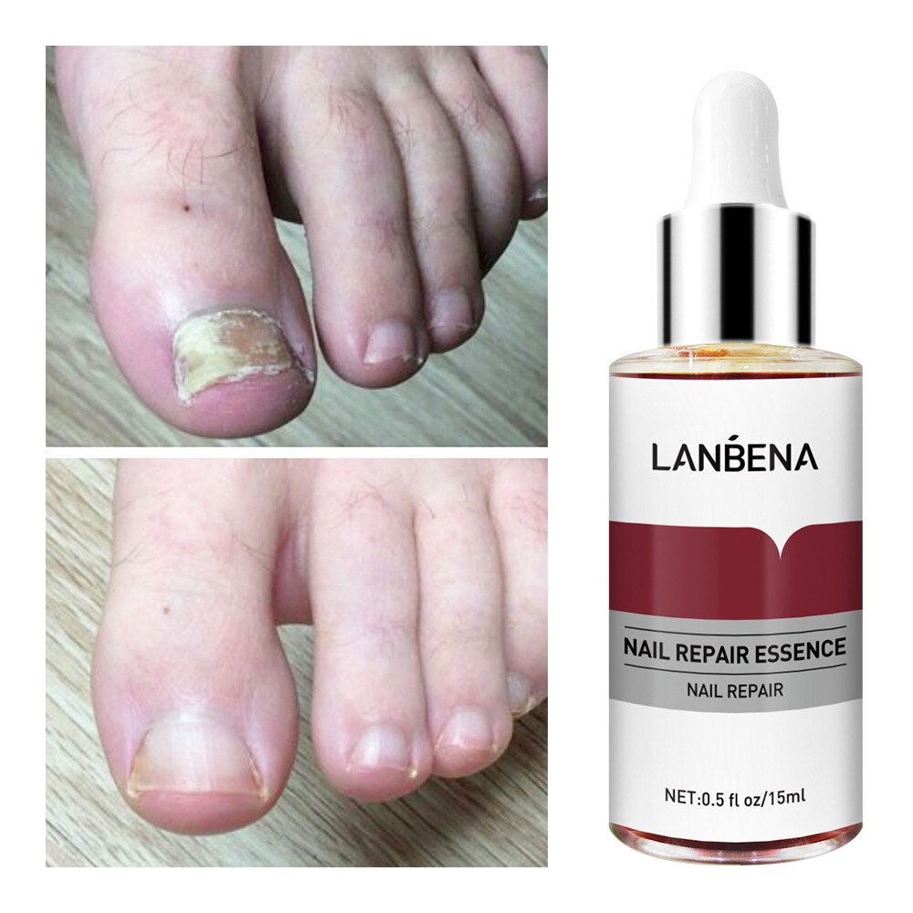 ORIGINAL Lanbena Kuku Perbaikan Essence Serum Jamur Perawatan Kuku