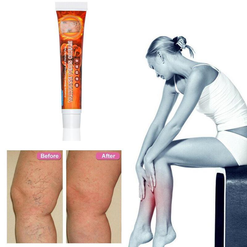 

CREAM HERBAL CHINA vaskulitis varises Radang urat darah