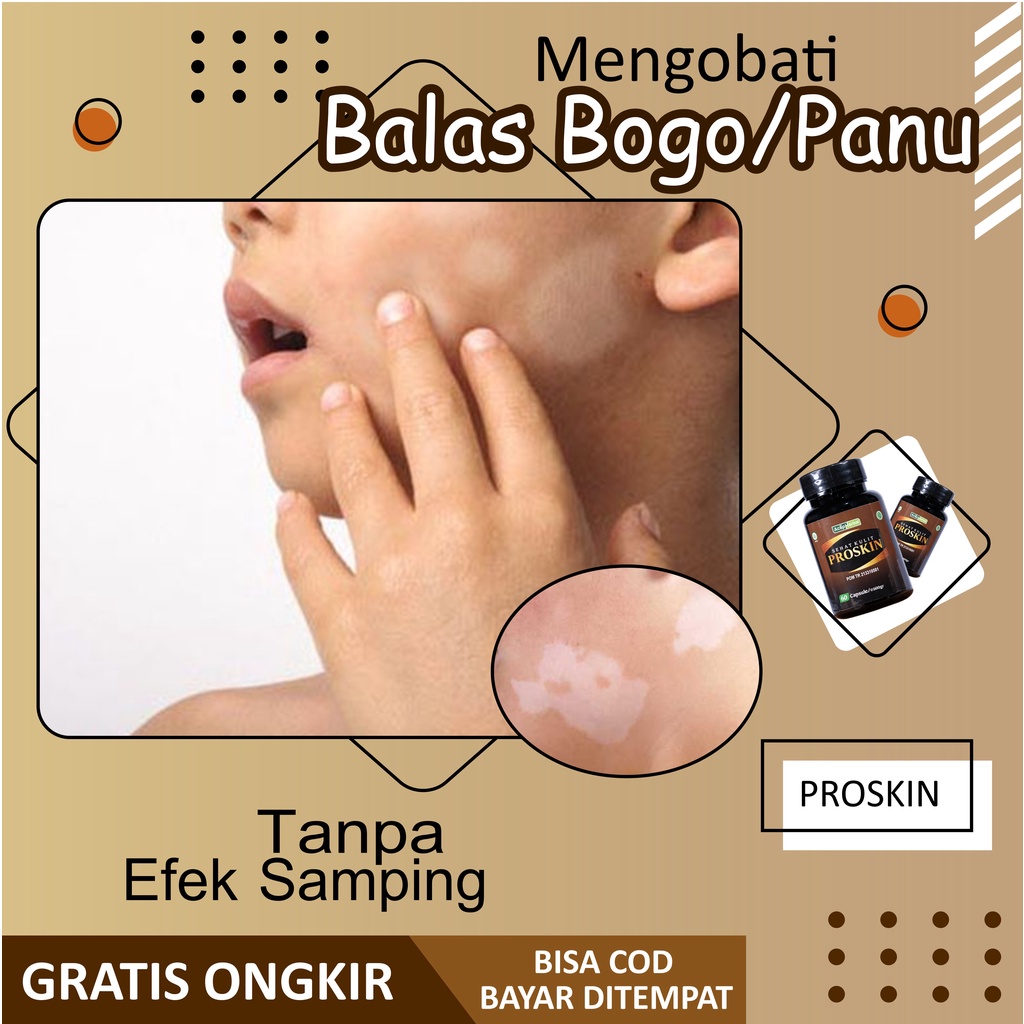 Obat Balas Bogo Gatal Jamur Kulit di Wajah Paling Alami untuk Penghilang Bercak Belang Putih Hapur p
