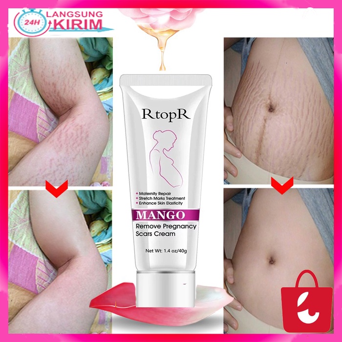 [Terbukti Alami] Rtopr Cream Penghilang Stretch Mark Bekas Luka Kerutan Tubuh Perut Ibu Hamil