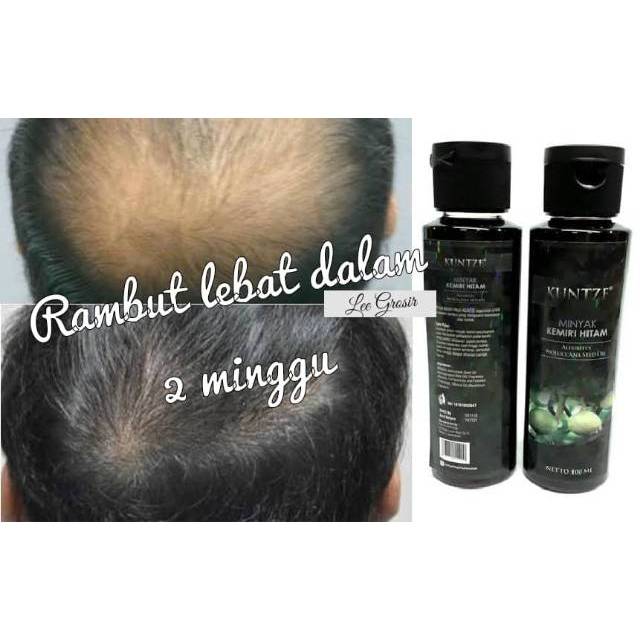 Jual Minyak Kemiri Penumbuh Tebal Rambut Hitam Lebat Obat Botak Penyubur Rambut Indonesia Shopee Indonesia