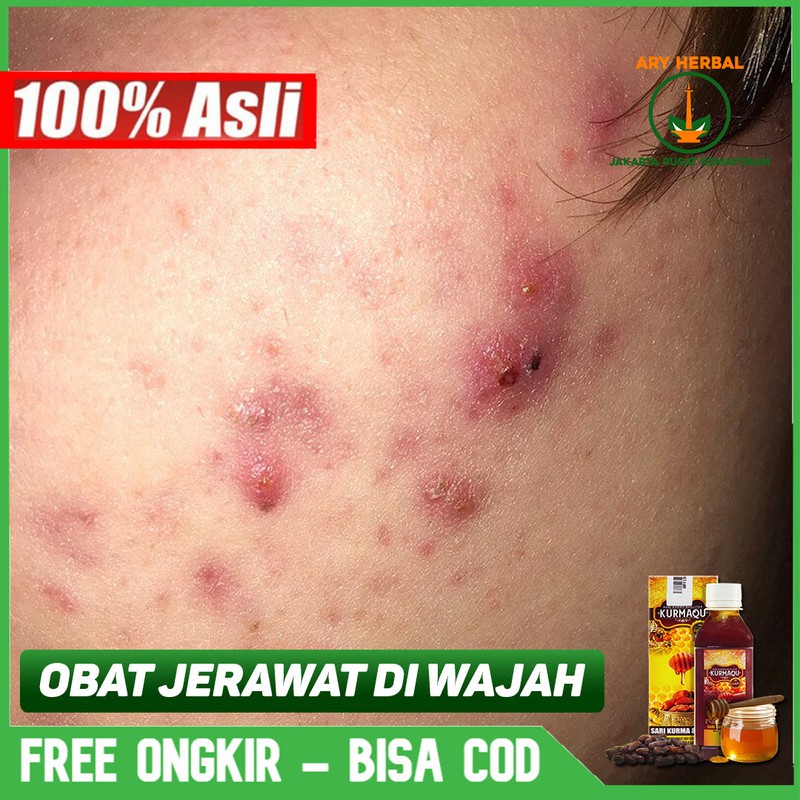 

Obat Jerawat Di Wajah, Jerawat Batu, Bopeng Alami Herbal Kurmaqu Sari Kurma Di Jakarta Pusat COD