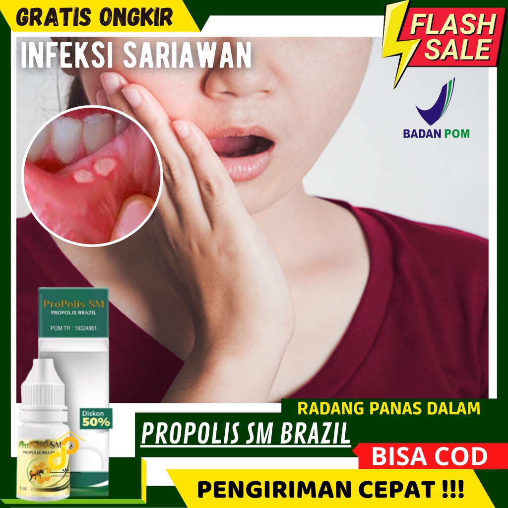 Rekomendasi Obat Sariawan Herbal - Sariawan Pada Anak, Sariawan Pada Anak - Sariawan di Tenggorokan,