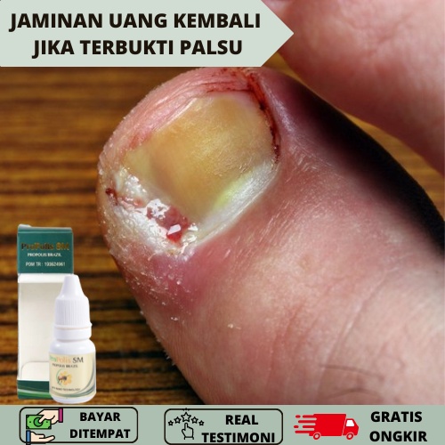 Obat Cantengan Jempol Kaki, Obat Jamur Kuku Cantengan, Cantengan Parah Bengkak dan Bernanah, Obat He