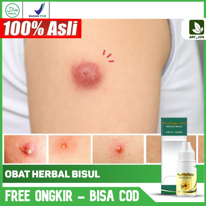 Obat Bisul - Penghilang Bisul - Benjolan Bernanah di Bokong Ketiak Kepala 100% Aman Propolis SM