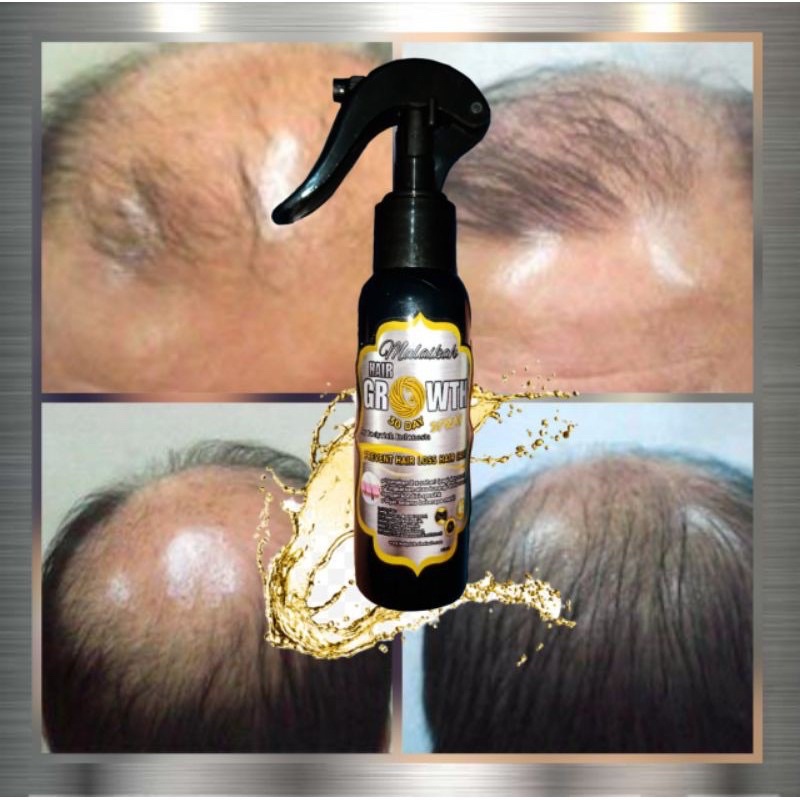 Serum Obat Penumbuh Rambut Botak dan Rontok Parah Malaikah Hair Growth