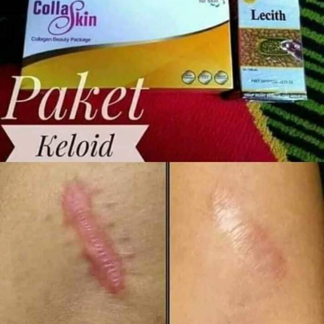Paket Penghilang Keloid Original Nasa Herbal