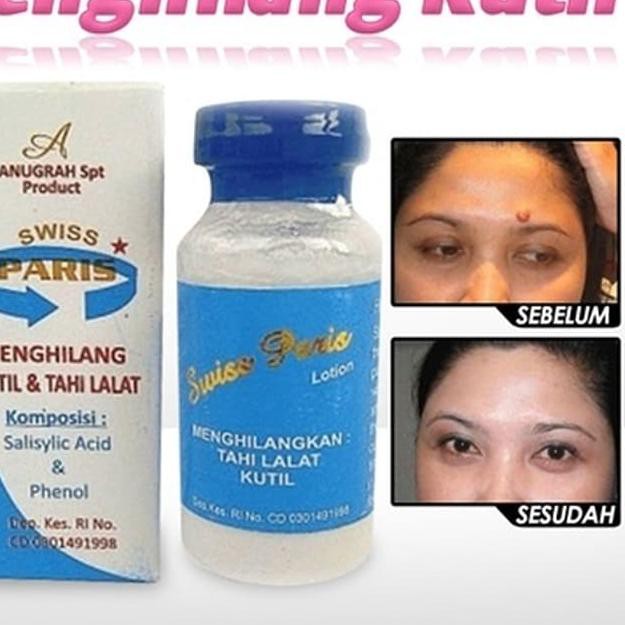 Swiss Paris Lotion - Penghilang Tahi / Tai LaLat Tanpa Operasi