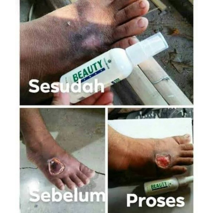 OBATI LUKA DIABETES - NBS NaturaBeautySpray DNA SALMON Original 100%- Serum Multifungsi