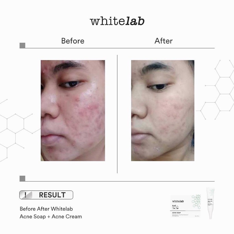 WHITELAB ACNE CREAM 10 GR