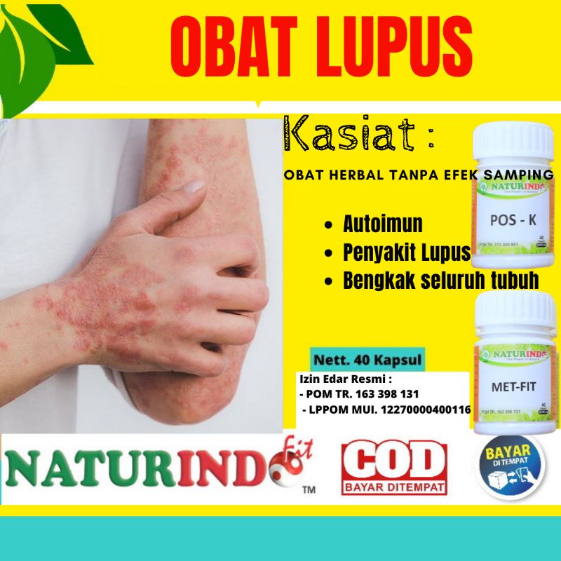 Obat Penyakit Lupus Ampuh Autoimun Daya Tahan Tubuh Meriyang Mriyang