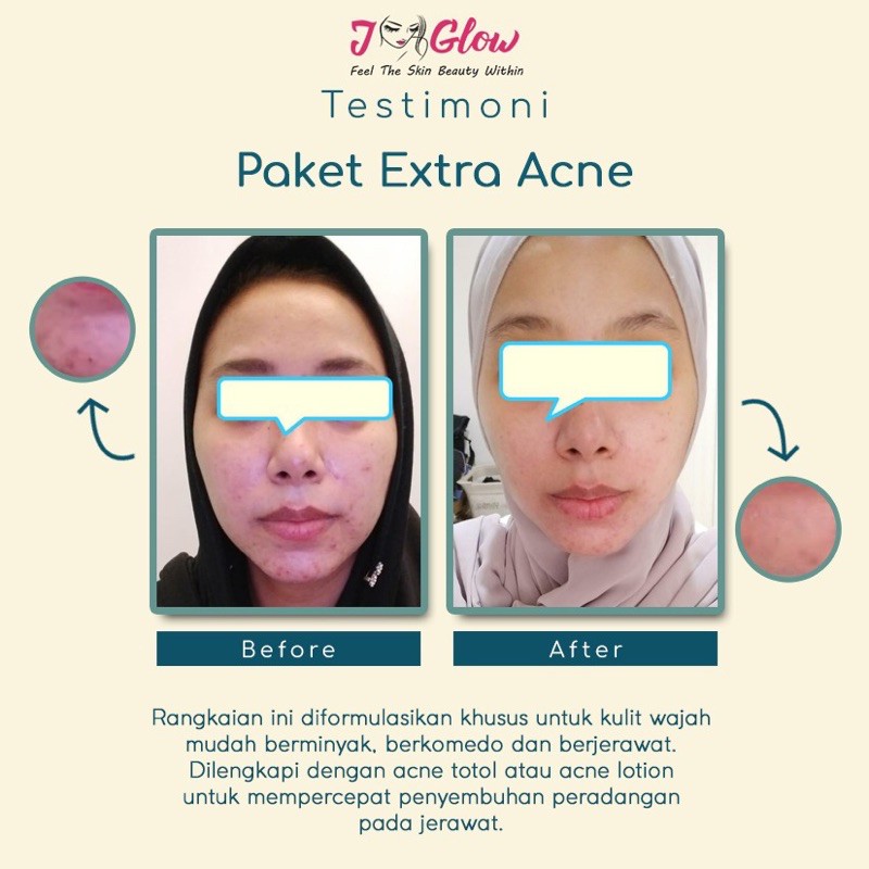 JGLOW SKINCARE EXTRA ACNE PERAWATAN MUKA JERAWAT 5pc