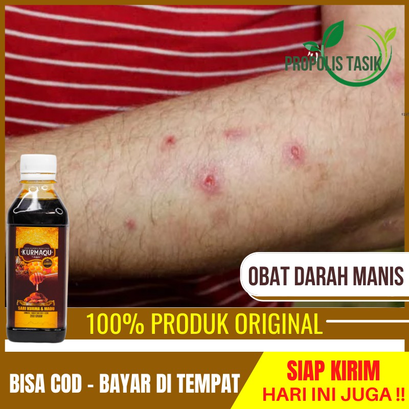 Obat Herbal Darah Manis, Gatal Prurigo, Amis Daging, Luka Darah Manis, Peradangan Ruam Pada Kulit