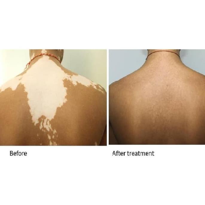 favorit] Lampu Vitiligo Psoriasis Fototerapi Narrowband UVB 311nm 2*20 Watt