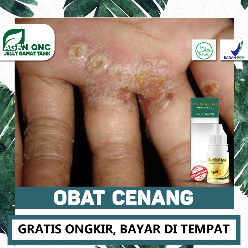 

Obat Cenang, Bisul Telur Kodok, Benjolan Bernanah - Kualitas PREMIUM Propolis SM 100% ASLI