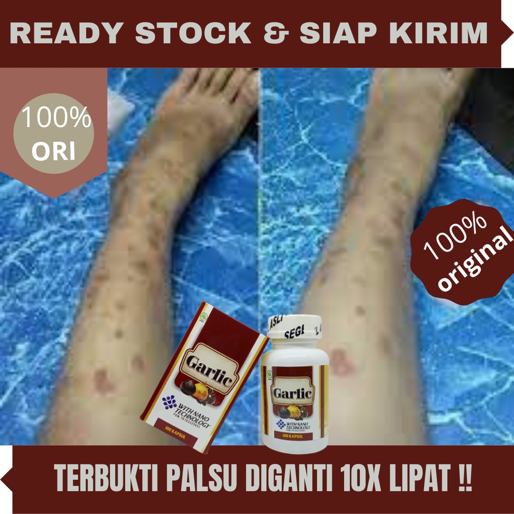 Obat Penghilang Koreng, Penghilang Koreng di Kaki, Penghilang Koreng di Muka, Penghilang Bekas Luka 