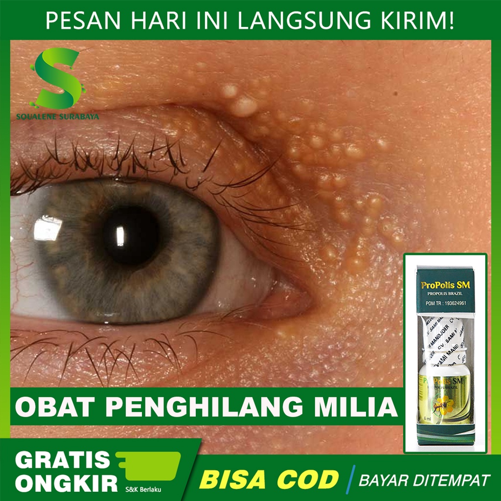 Jual Obat Penghilang Milia Penghilang Milia Di Bawah Mata