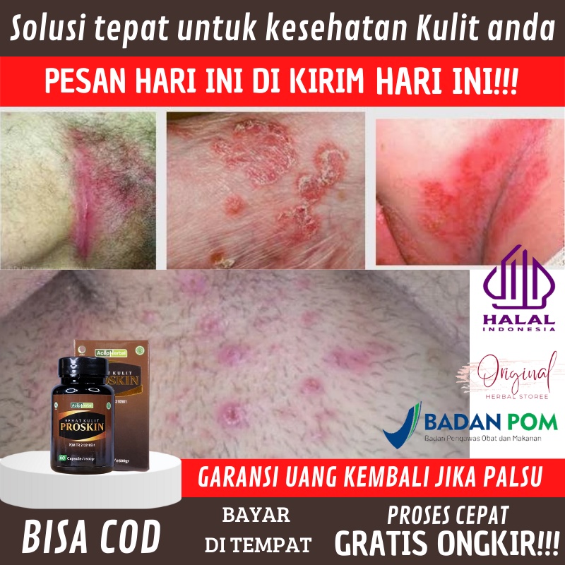 Obat Gatal Kelamin, Obat Kelamin Lecet / Bintik Merah / Gatal,  Obat Gatal Buah Zakar, Obat Gatal mi