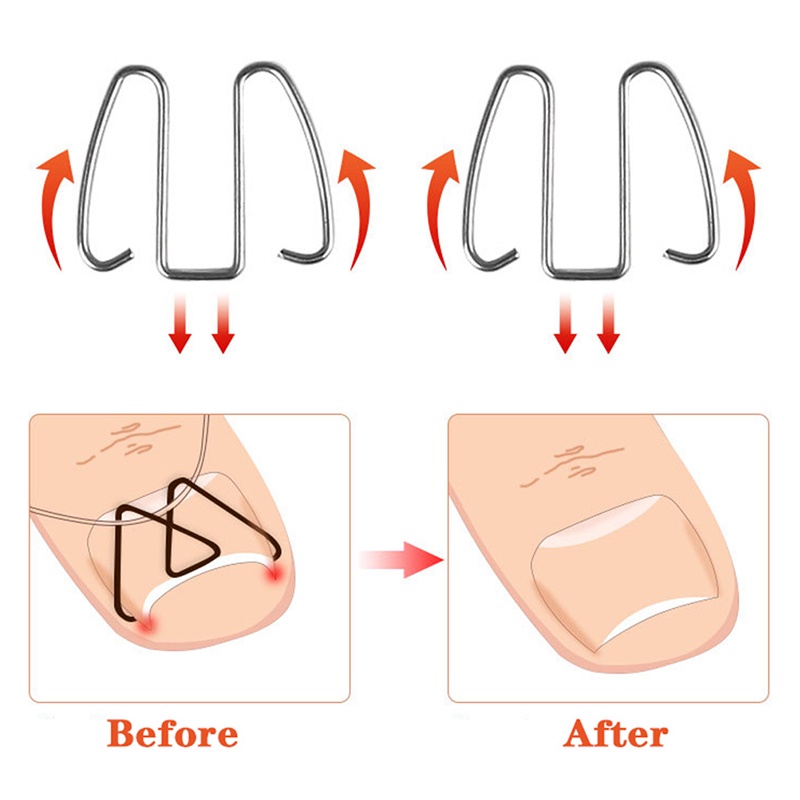 Alat Koreksi Kuku Kaki Tumbuh Ke Dalam Paronychia