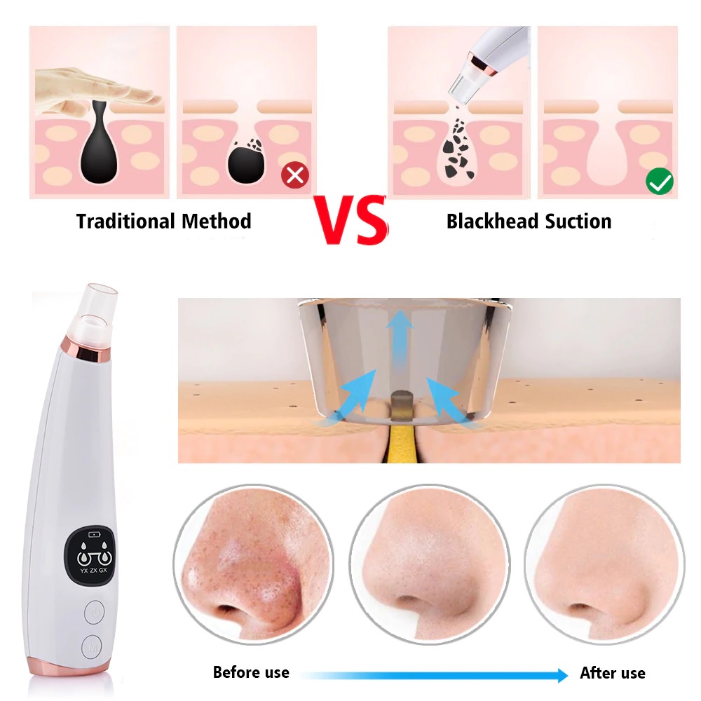 Vacuum Suction Komedo Wajah Skin Face Care Blackhead Pore Cleaner 6 Heads - MC-004