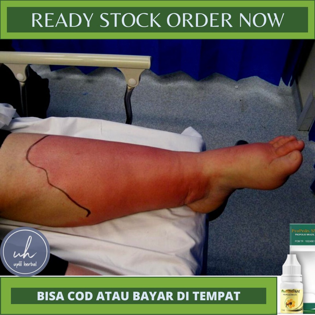 OBAT SELULITIS ALAMI, OBAT HERBAL SELULITIS, OBAT INFEKSI BAKTERI DIKULIT, OBAT KULIT KEMERAHAN, BEN