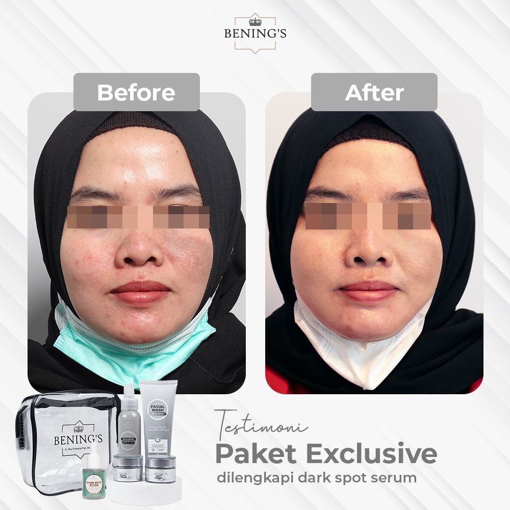 BENING'S SKINCARE PAKET EXCLUSIVE PAKETAN FLEK DAN GLOWING