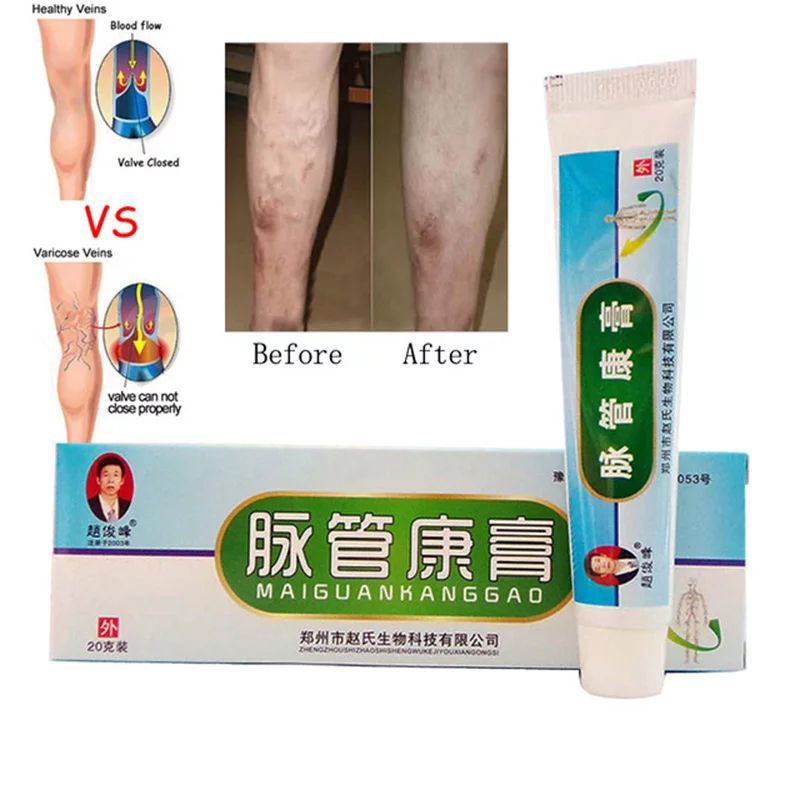 Salep Obat Penghilang Varises Kaki Paling Ampuh Original Varicose Veins Treatment Cream Krim Bpom