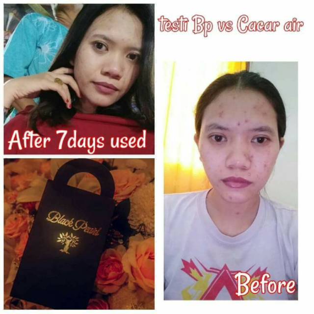 Sabun BLACK PEARL /sabun menghilangkan bekas cacar /bekas luka