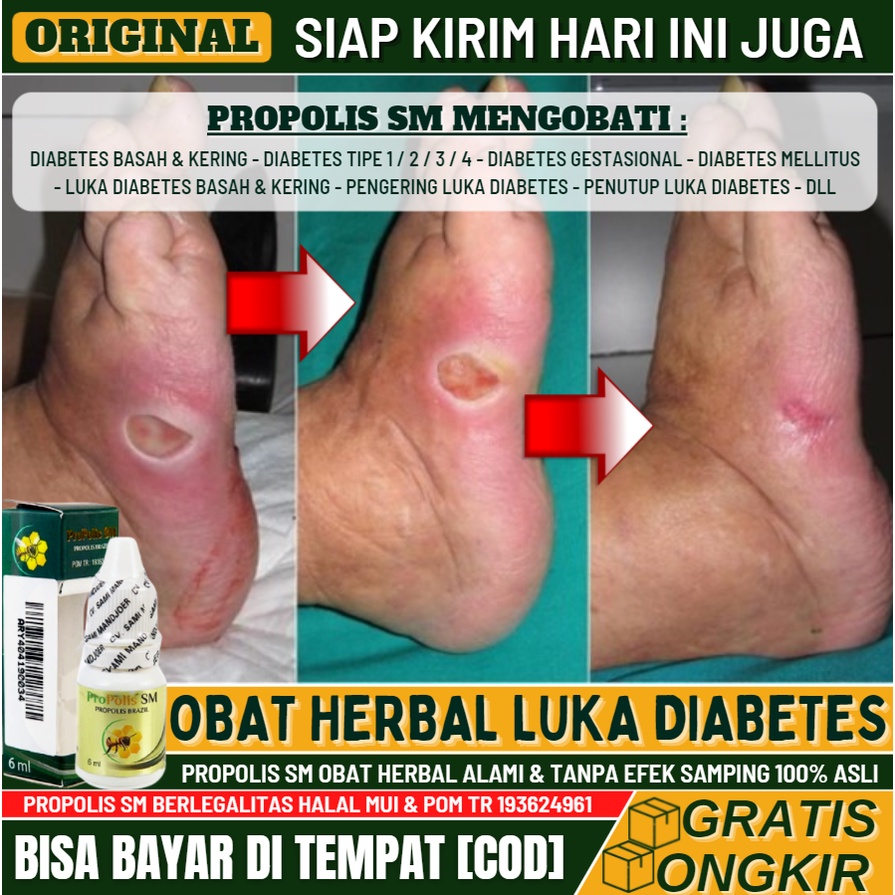 Obat Oles Luka Diabetes Alami, Obat Salep Luka Diabetes, Obat Luka Gangren Diabetes, Obat Luka Basah