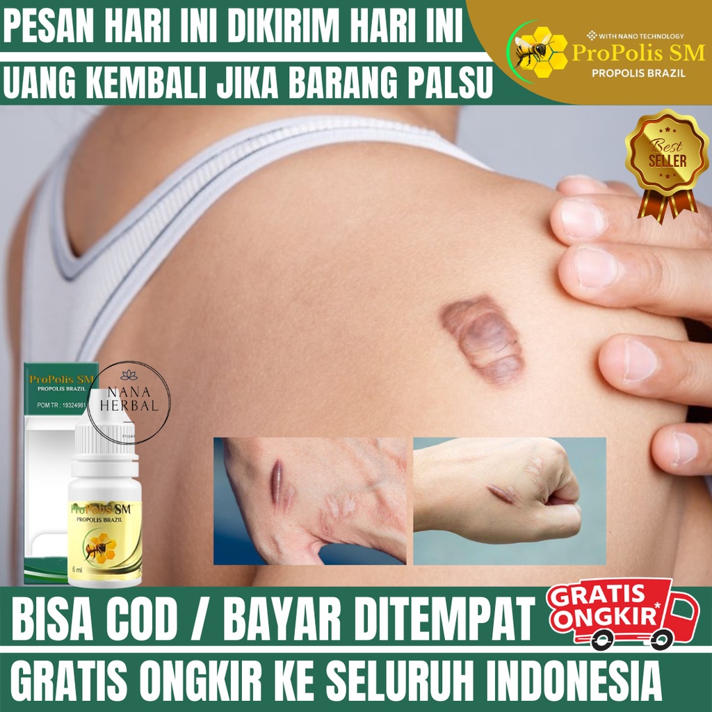 Obat Untuk Menghilangkan Keloid Yang Sudah Lama, Obat Menghilangkan Bekas Luka Menonjol, Obat Keloid