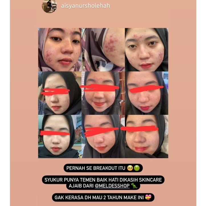 CREAM MALAM ACNE/JERAWAT BY AMSKINCARE | AMPUH USIR JERAWAT BANDEL BERUNTUSAN BOPENG