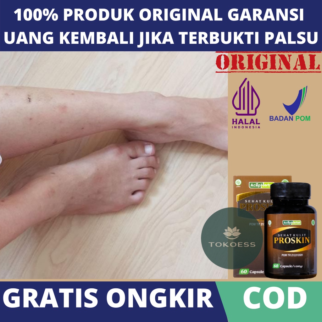 Obat Penghilang Bekas Luka Koreng Lama Hitam, Obat Herbal Menghilangkan Bekas Luka Lama Hitam Koreng