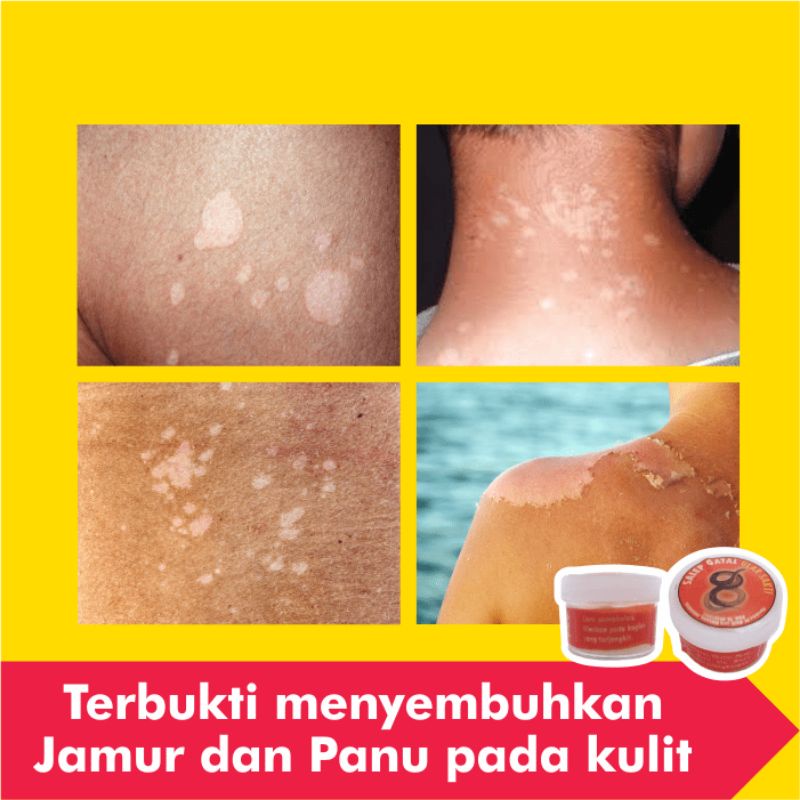 Obat Salep Panu Paling Ampuh Gatal Kulit Kurap Kutu Air Jamur Selangkangan Gatel Eksim Jerawat Kudis-4