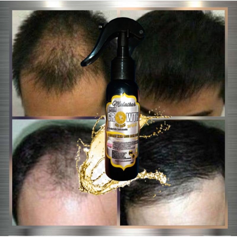 Serum Obat Penumbuh Rambut Botak dan Rontok Parah Malaikah Hair Growth