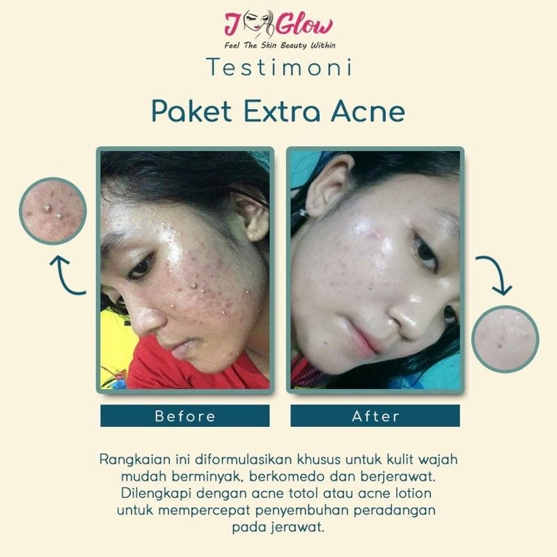 jglow skincare paket ekstra acne / J-glow skincare paket ekstra acne / j glow skincare ekstra acne