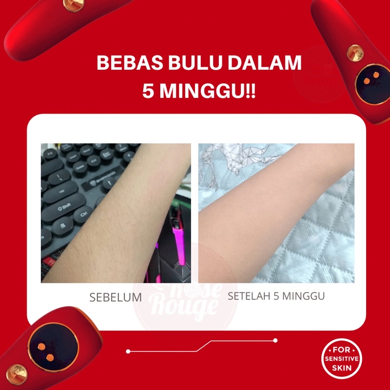 IPL Dingin Penghilang Bulu - Cold IPL Hair Removal Permanent - Laser Penghilang Bulu Permanen