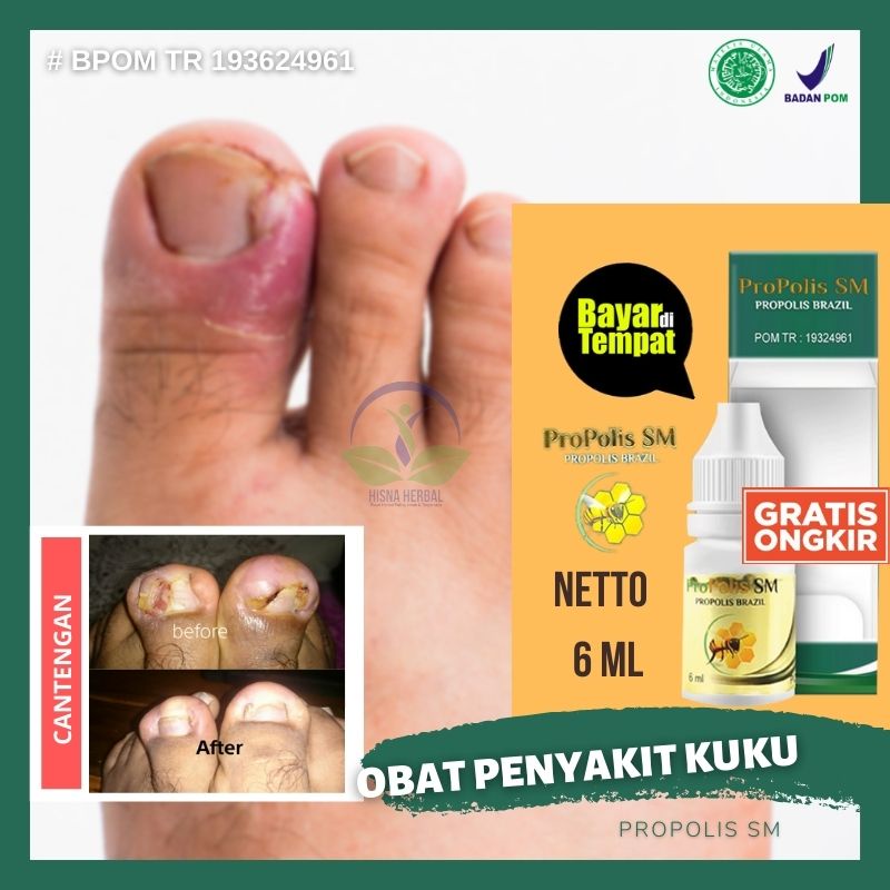  OBAT  CANTENGAN SAKIT  KUKU JARI JEMPOL  KAKI TANGAN  BENGKAK 